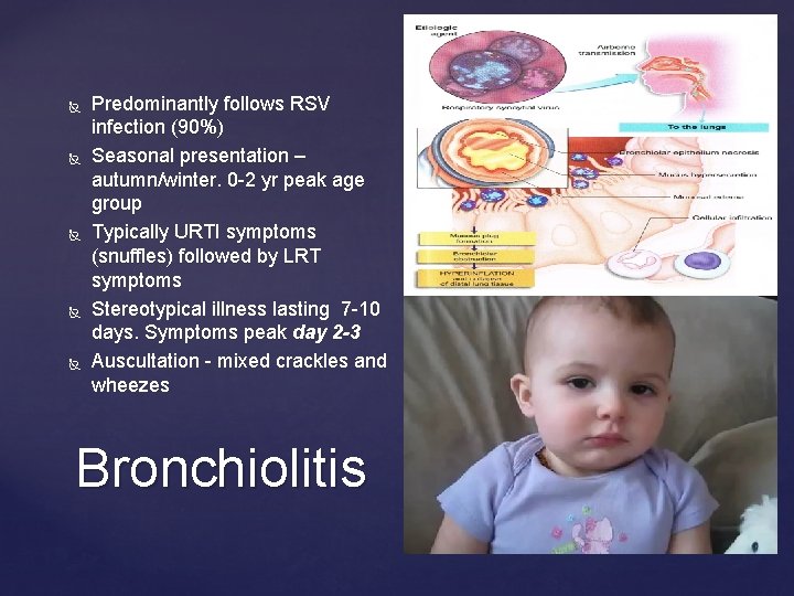  Predominantly follows RSV infection (90%) Seasonal presentation – autumn/winter. 0 -2 yr peak