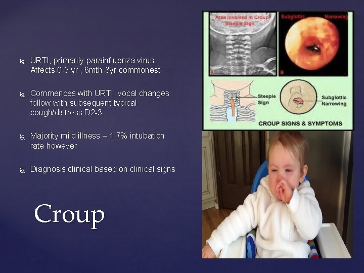  URTI, primarily parainfluenza virus. Affects 0 -5 yr , 6 mth-3 yr commonest