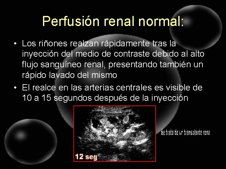 Perfusión renal normal: • Los riñones realzan rápidamente tras la inyección del medio de