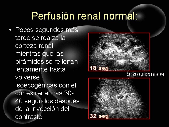 Perfusión renal normal: • Pocos segundos más tarde se realza la corteza renal, mientras