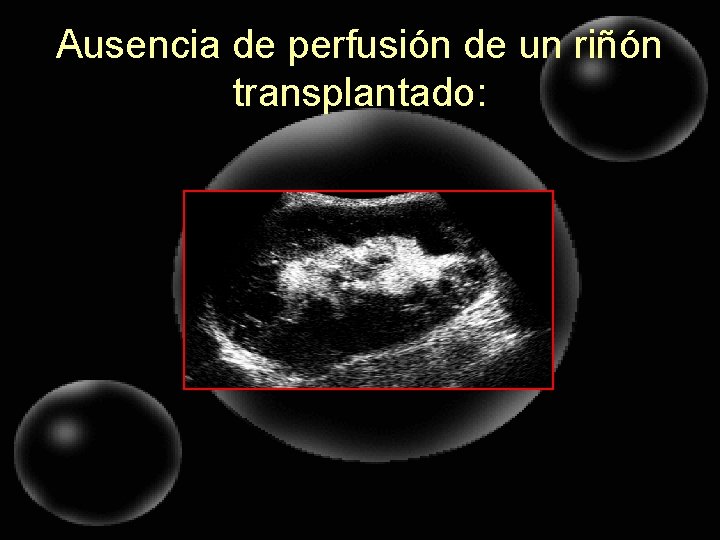 Ausencia de perfusión de un riñón transplantado: 