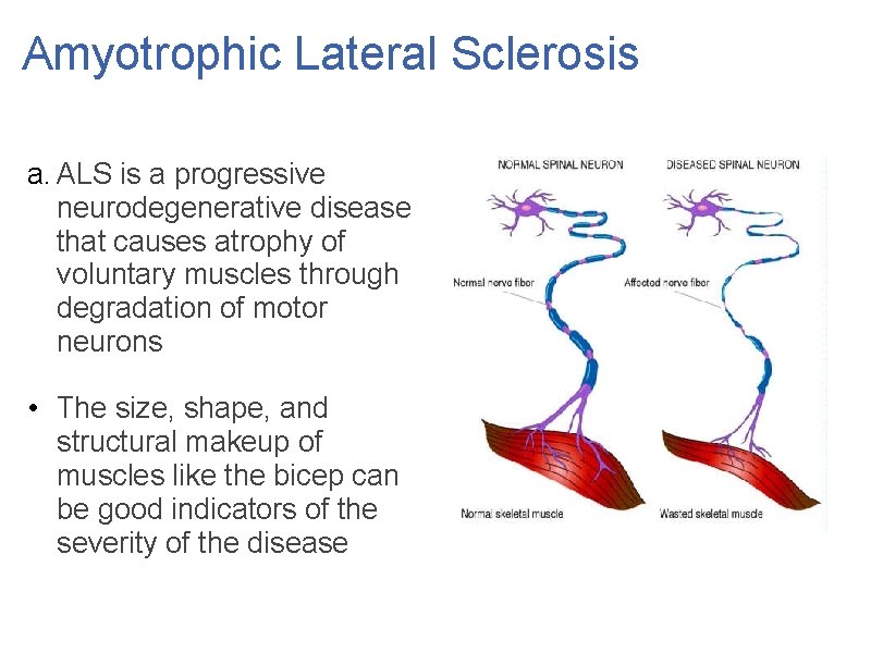 Amyotrophic Lateral Sclerosis a. ALS is a progressive neurodegenerative disease that causes atrophy of