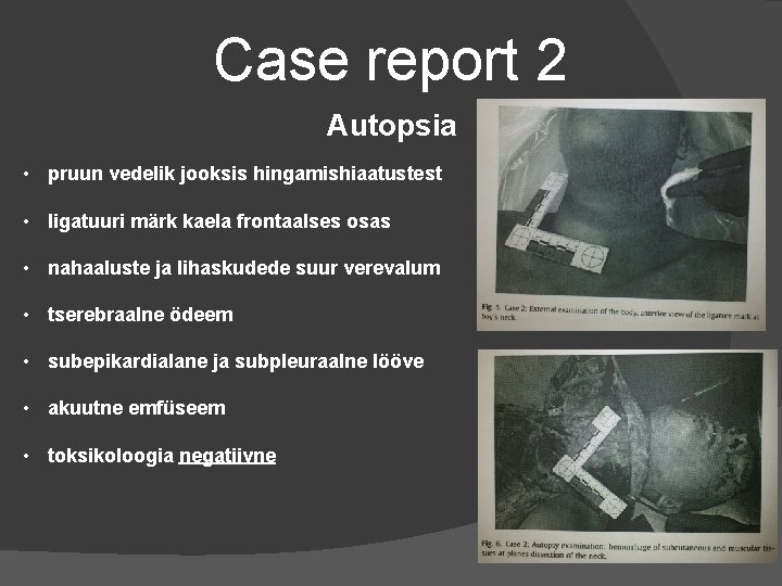 Case report 2 Autopsia • pruun vedelik jooksis hingamishiaatustest • ligatuuri märk kaela frontaalses