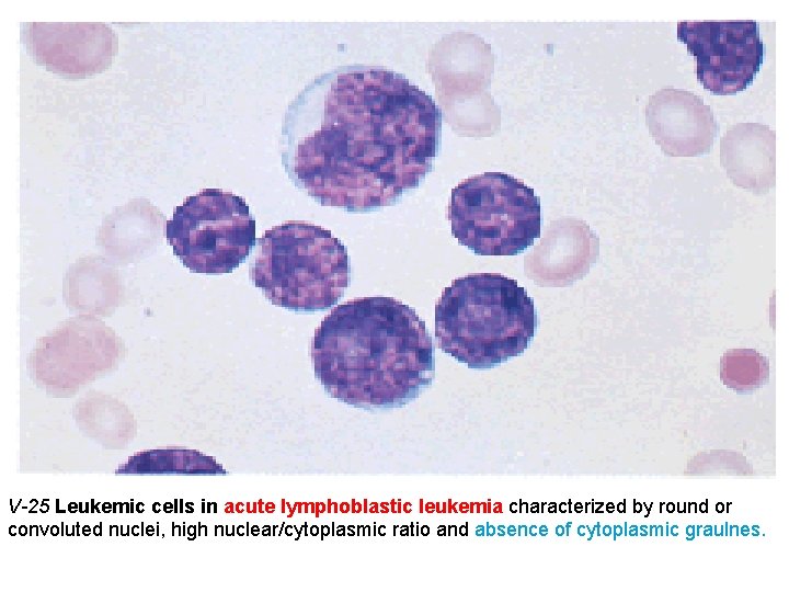 V-25 Leukemic cells in acute lymphoblastic leukemia characterized by round or convoluted nuclei, high