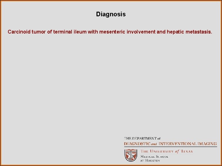 Diagnosis Carcinoid tumor of terminal ileum with mesenteric involvement and hepatic metastasis. 