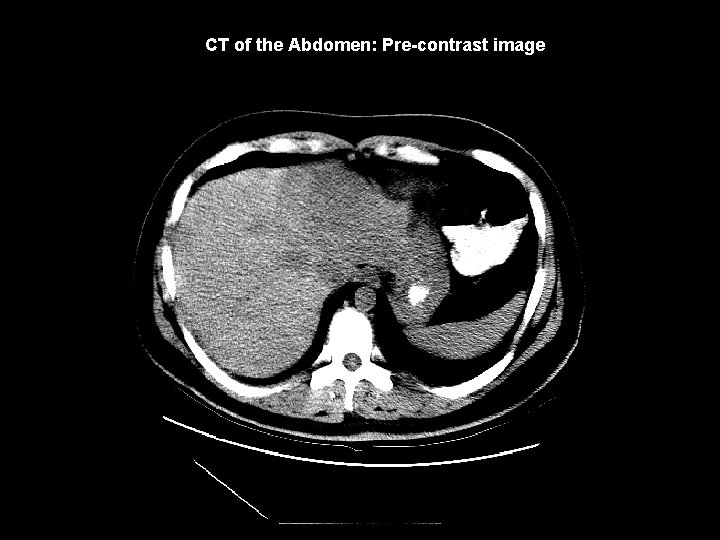 CT of the Abdomen: Pre-contrast image 