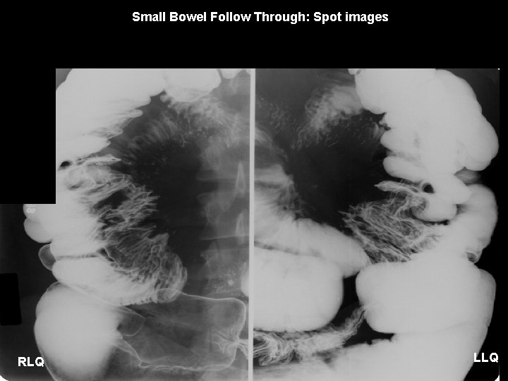 Small Bowel Follow Through: Spot images RLQ LLQ 