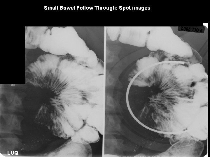 Small Bowel Follow Through: Spot images LUQ 