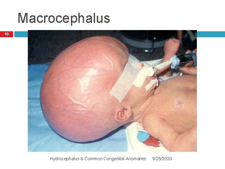 Macrocephalus 10 Hydrocephalus & Common Congenital Anomalies 9/25/2020 