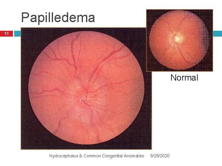 Papilledema 13 Normal Hydrocephalus & Common Congenital Anomalies 9/25/2020 