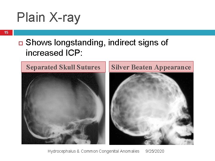 Plain X-ray 15 Shows longstanding, indirect signs of increased ICP: Separated Skull Sutures Silver