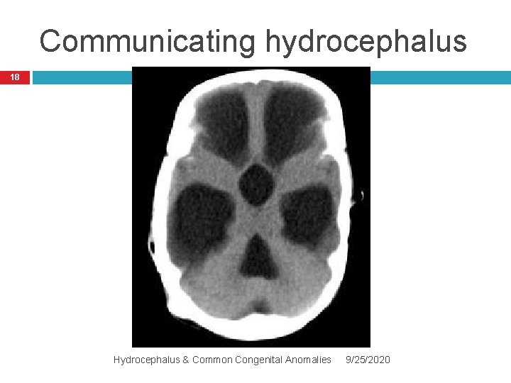 Communicating hydrocephalus 18 Hydrocephalus & Common Congenital Anomalies 9/25/2020 