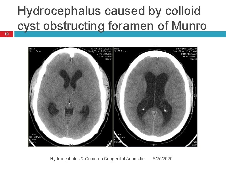 19 Hydrocephalus caused by colloid cyst obstructing foramen of Munro Hydrocephalus & Common Congenital