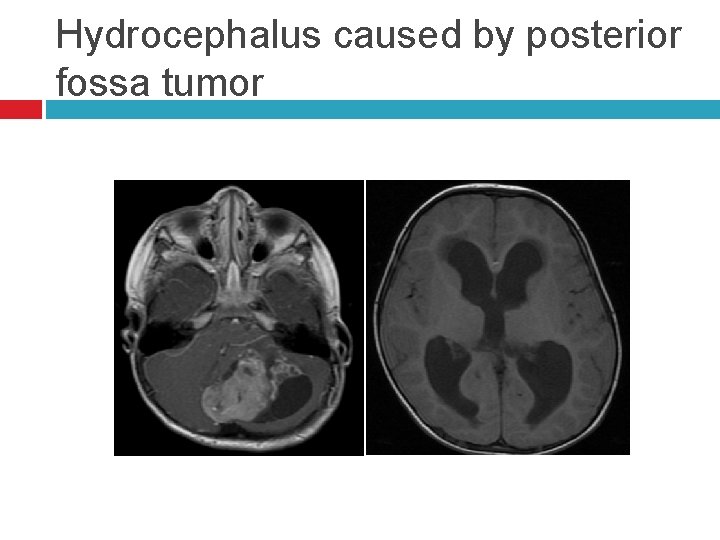 Hydrocephalus caused by posterior fossa tumor 