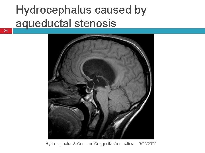 21 Hydrocephalus caused by aqueductal stenosis Hydrocephalus & Common Congenital Anomalies 9/25/2020 