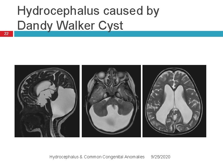 22 Hydrocephalus caused by Dandy Walker Cyst Hydrocephalus & Common Congenital Anomalies 9/25/2020 