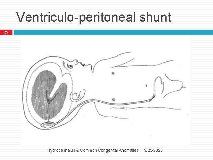 Ventriculo-peritoneal shunt 25 Hydrocephalus & Common Congenital Anomalies 9/25/2020 