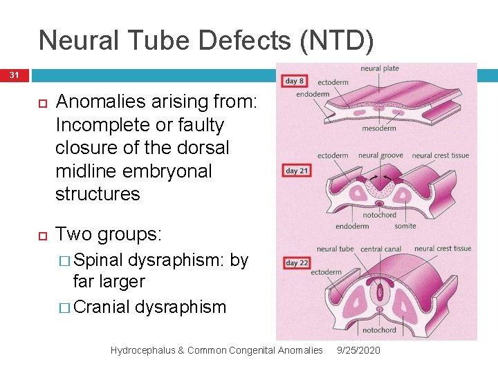 Neural Tube Defects (NTD) 31 Anomalies arising from: Incomplete or faulty closure of the