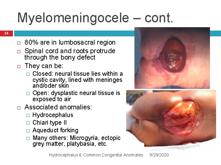 Myelomeningocele – cont. 34 80% are in lumbosacral region Spinal cord and roots protrude