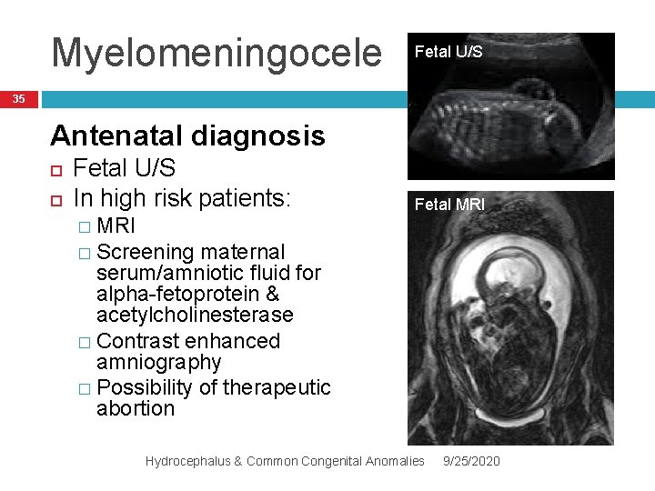 Myelomeningocele Fetal U/S 35 Antenatal diagnosis Fetal U/S In high risk patients: � MRI