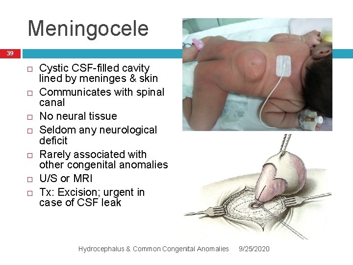Meningocele 39 Cystic CSF-filled cavity lined by meninges & skin Communicates with spinal canal