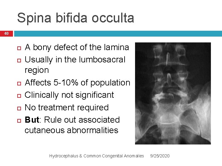 Spina bifida occulta 40 A bony defect of the lamina Usually in the lumbosacral
