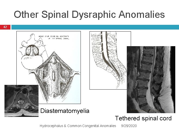 Other Spinal Dysraphic Anomalies 42 Diastematomyelia Tethered spinal cord Hydrocephalus & Common Congenital Anomalies