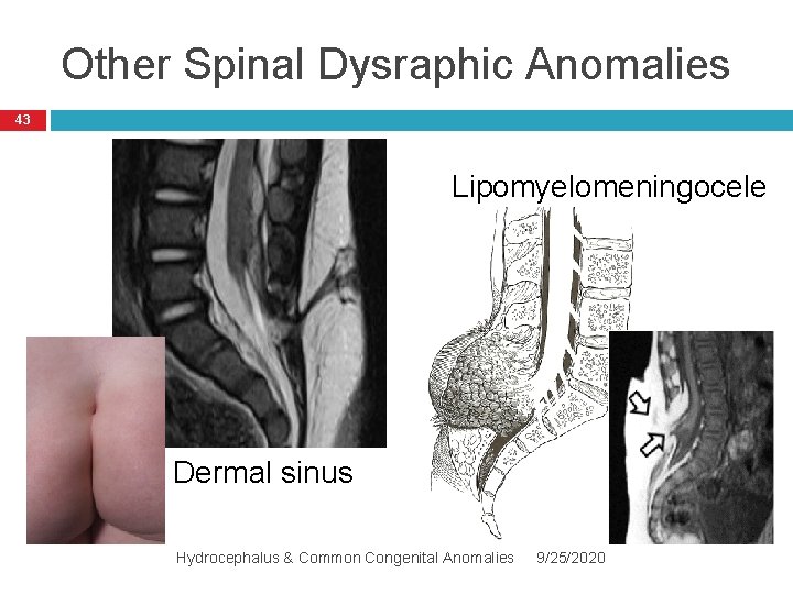 Other Spinal Dysraphic Anomalies 43 Lipomyelomeningocele Dermal sinus Hydrocephalus & Common Congenital Anomalies 9/25/2020