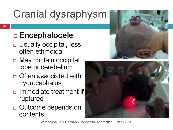 Cranial dysraphysm 44 Encephalocele Usually occipital, less often ethmoidal May contain occipital lobe or