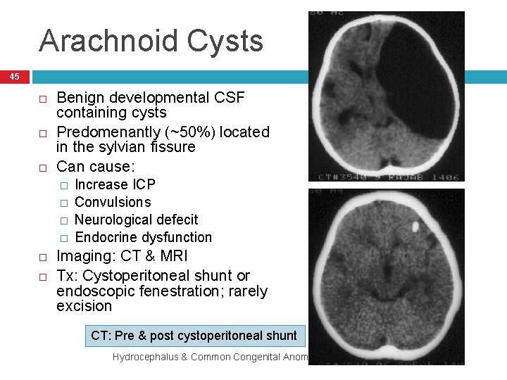 Arachnoid Cysts 45 Benign developmental CSF containing cysts Predomenantly (~50%) located in the sylvian