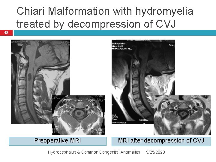 Chiari Malformation with hydromyelia treated by decompression of CVJ 48 Preoperative MRI after decompression