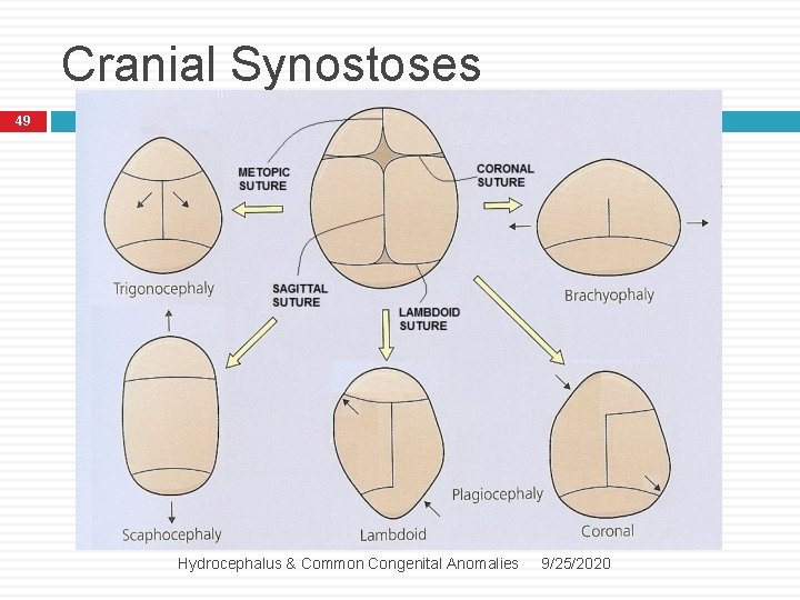 Cranial Synostoses 49 Hydrocephalus & Common Congenital Anomalies 9/25/2020 