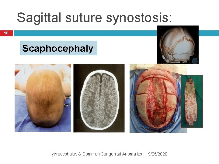 Sagittal suture synostosis: 50 Scaphocephaly Hydrocephalus & Common Congenital Anomalies 9/25/2020 