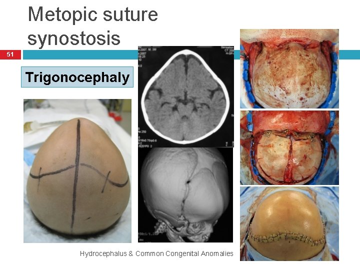 Metopic suture synostosis 51 Trigonocephaly Hydrocephalus & Common Congenital Anomalies 9/25/2020 
