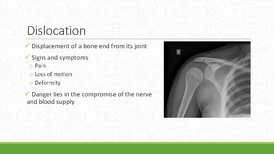 Dislocation ü Displacement of a bone end from its joint ü Signs and symptoms