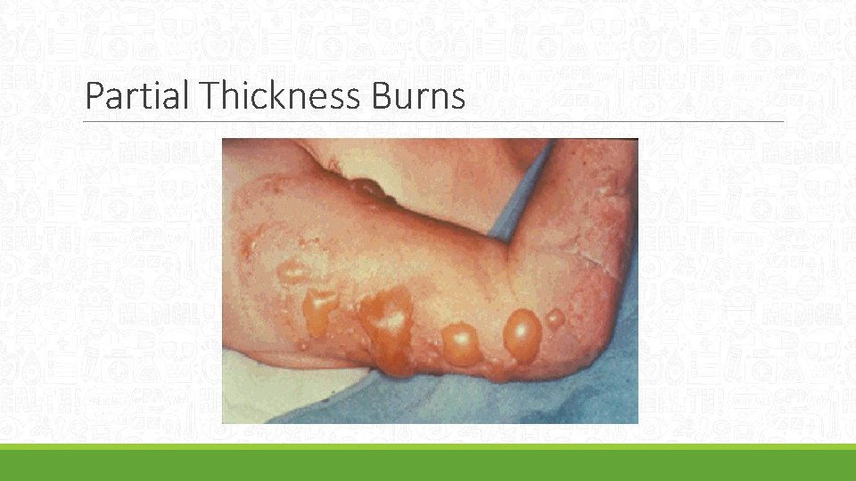 Partial Thickness Burns 