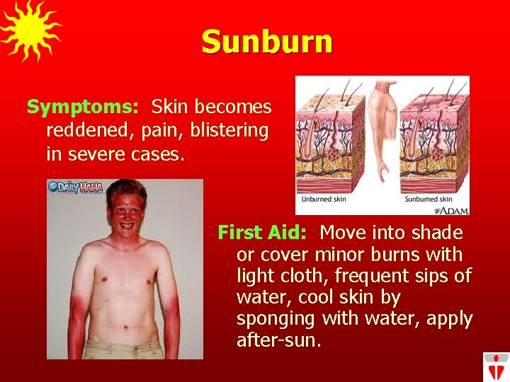 Sunburn Symptoms: Skin becomes reddened, pain, blistering in severe cases. First Aid: Move into