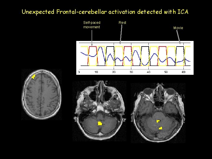 Unexpected Frontal-cerebellar activation detected with ICA Self-paced movement Rest Movie 
