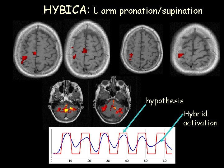 HYBICA: L arm pronation/supination hypothesis Hybrid activation 