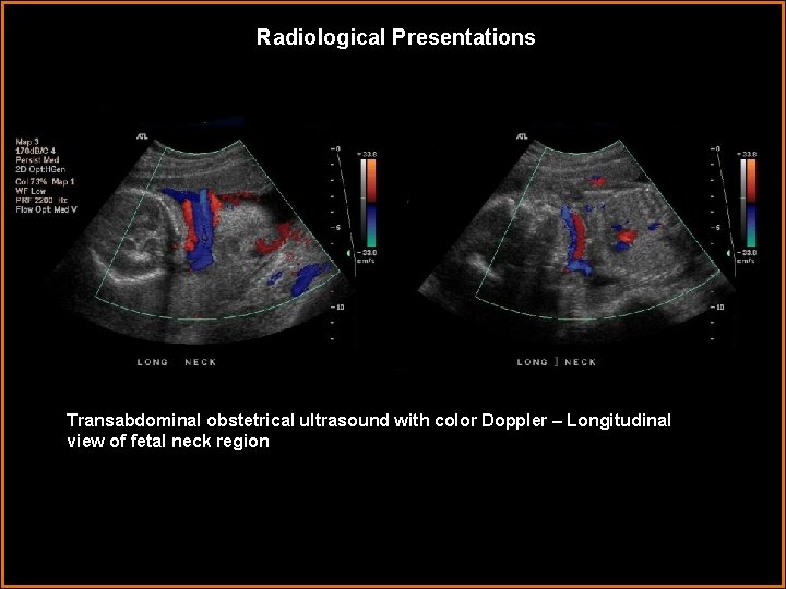 Radiological Presentations Transabdominal obstetrical ultrasound with color Doppler – Longitudinal view of fetal neck