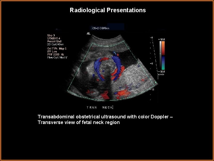 Radiological Presentations Transabdominal obstetrical ultrasound with color Doppler – Transverse view of fetal neck