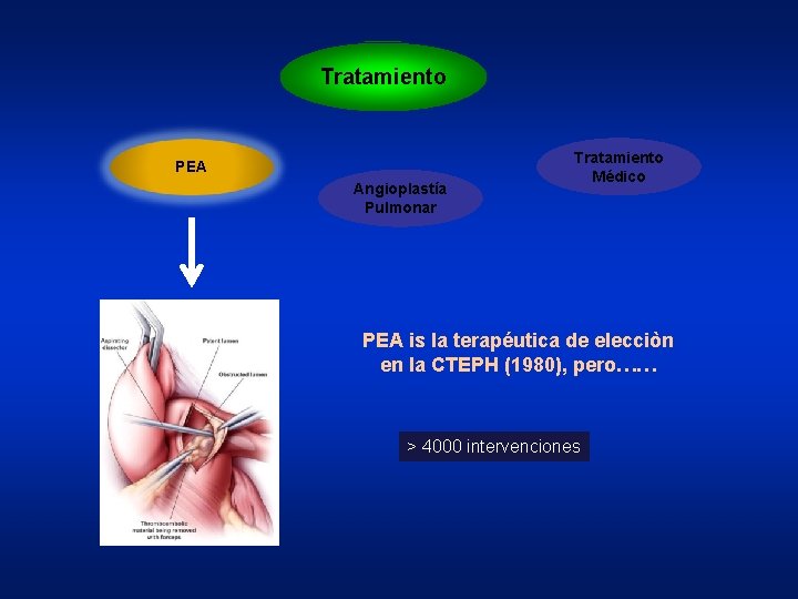Tratamiento PEA Angioplastía Pulmonar Tratamiento Médico PEA is la terapéutica de elecciòn en la