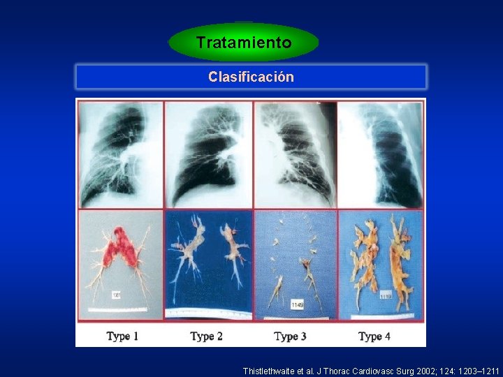 Tratamiento Clasificación Thistlethwaite et al. J Thorac Cardiovasc Surg 2002; 124: 1203– 1211 