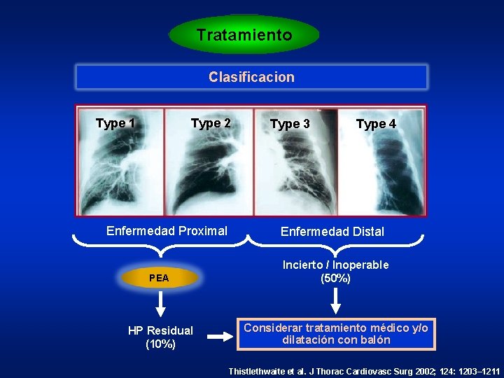 Tratamiento Clasificacion Type 2 Type 1 Enfermedad Proximal Type 3 Type 4 Enfermedad Distal