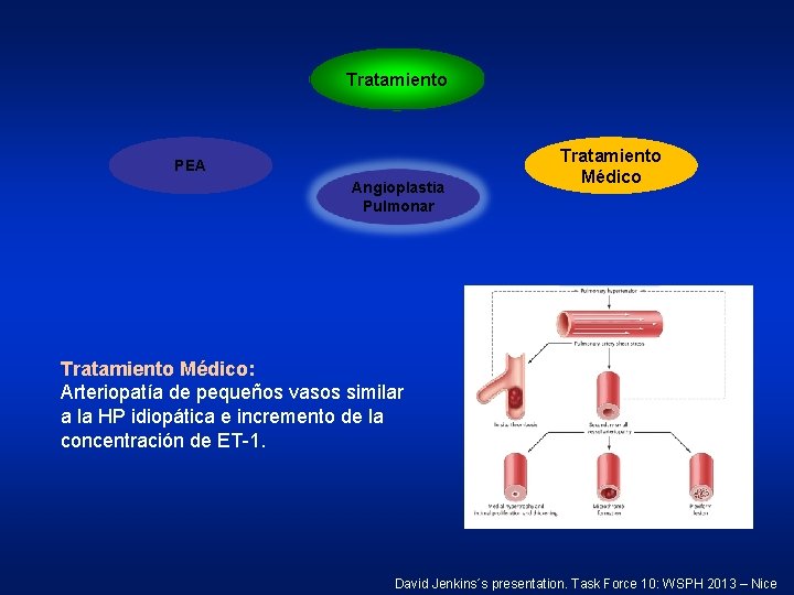 Tratamiento PEA Angioplastia Pulmonar Tratamiento Médico: Arteriopatía de pequeños vasos similar a la HP