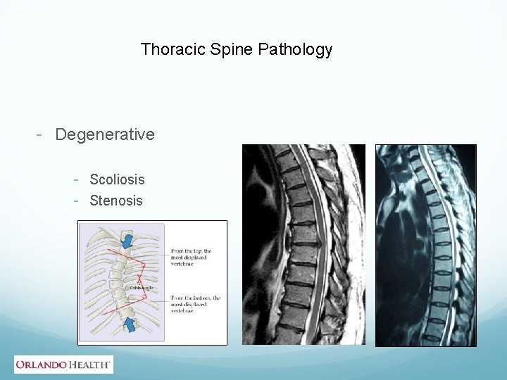 Thoracic Spine Pathology - Degenerative - Scoliosis - Stenosis 