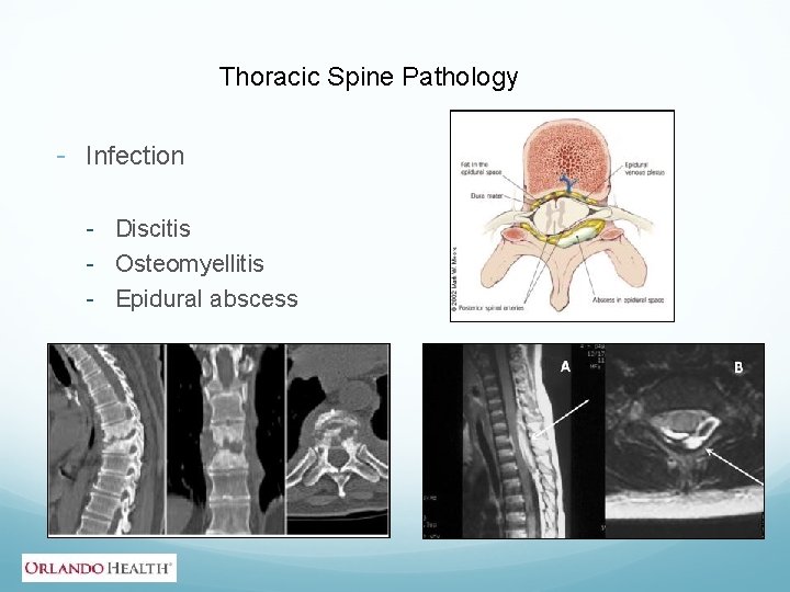 Thoracic Spine Pathology - Infection - Discitis - Osteomyellitis - Epidural abscess 