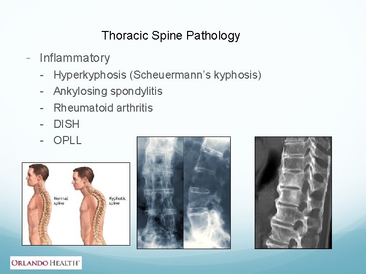 Thoracic Spine Pathology - Inflammatory - Hyperkyphosis (Scheuermann’s kyphosis) Ankylosing spondylitis Rheumatoid arthritis DISH