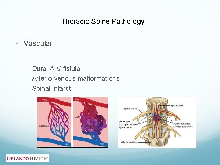 Thoracic Spine Pathology - Vascular - Dural A-V fistula - Arterio-venous malformations - Spinal