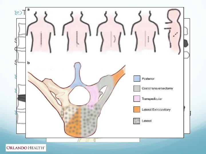  Thoracic pathology surgical options Surgical tools include: hooks, wiring, bands, screws, rods, cages,